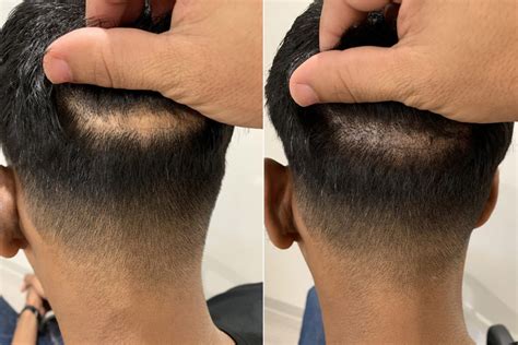 colmek+smp|Scalp Micropigmentation in Miami for Hair Loss Solutions